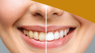 clareamento-dental