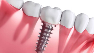 implantes-dentais